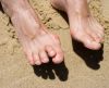 Vbočený palec (Hallux valgus)
