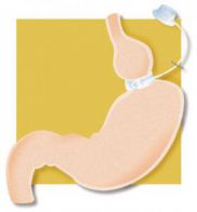 lapband5