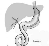 k-millergastric_sleeve_g