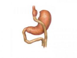 lapgastricbypass_pix