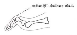 prst2