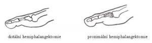 prst3