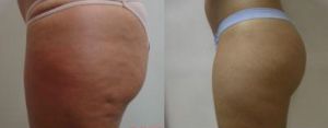 +-cellulite_bef-1-sl