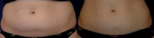 +-cellulite4_bef-3-sl