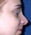 Operace nosu (Rhinoplastika)