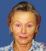 Face-lift (Rhytidektomie), SMAS face-lift