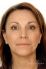 Esthelis, Restylane, Juvéderm, Surgiderm, Teosyal, Matridex, Matridur, Princess (preparáty kyseliny hyaluronové)