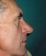 Operace nosu (Rhinoplastika)