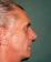 Operace nosu (Rhinoplastika)