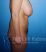 Modelace prsou (Breast-lift)
