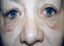 Operace očních víček (Blepharoplastika)