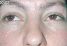 Fotorejuvenace / Resurfacing
