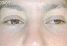 Fotorejuvenace / Resurfacing