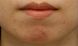 Fotorejuvenace / Resurfacing