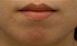 Fotorejuvenace / Resurfacing