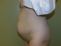 Abdominoplastika (Operace břicha)