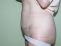Abdominoplastika (Operace břicha)