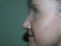 Operace nosu (Rhinoplastika)