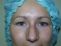 Operace očních víček (Blepharoplastika)