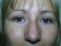 Operace očních víček (Blepharoplastika)