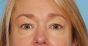 Operace očních víček (Blepharoplastika)