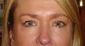 Operace očních víček (Blepharoplastika)