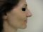 Operace nosu (Rhinoplastika)