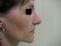 Operace nosu (Rhinoplastika)