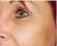 Fotorejuvenace / Resurfacing