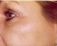 Fotorejuvenace / Resurfacing