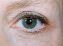 Operace očních víček (Blepharoplastika)