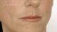 Esthelis, Restylane, Juvéderm, Surgiderm, Teosyal, Matridex, Matridur, Princess (preparáty kyseliny hyaluronové)