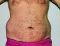 Liposukce