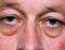 Operace očních víček (Blepharoplastika)