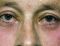 Operace očních víček (Blepharoplastika)