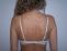 Fotorejuvenace / Resurfacing