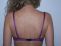 Fotorejuvenace / Resurfacing