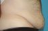 Abdominoplastika (Operace břicha)