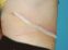 Abdominoplastika (Operace břicha)