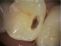 Zubní výplně