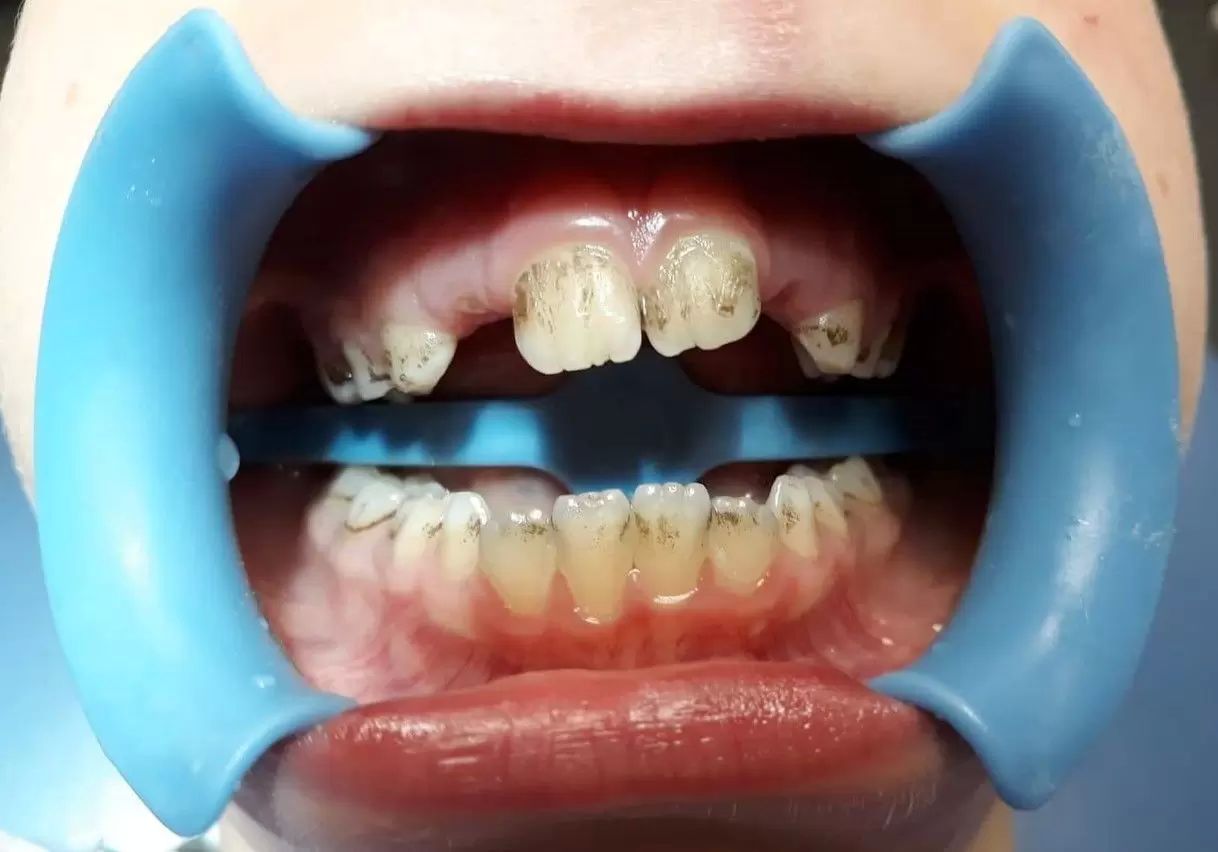 Jak se zbavit žlutého povlaků na zubech?