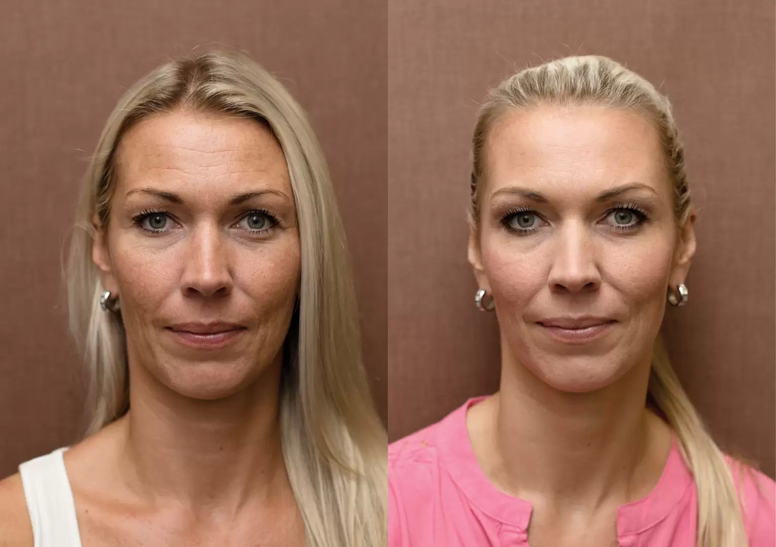 Fotky před a po zákroku estetické dermatologie: chemicky peeling, skinbooster, plasmaterapie, botolutoxin