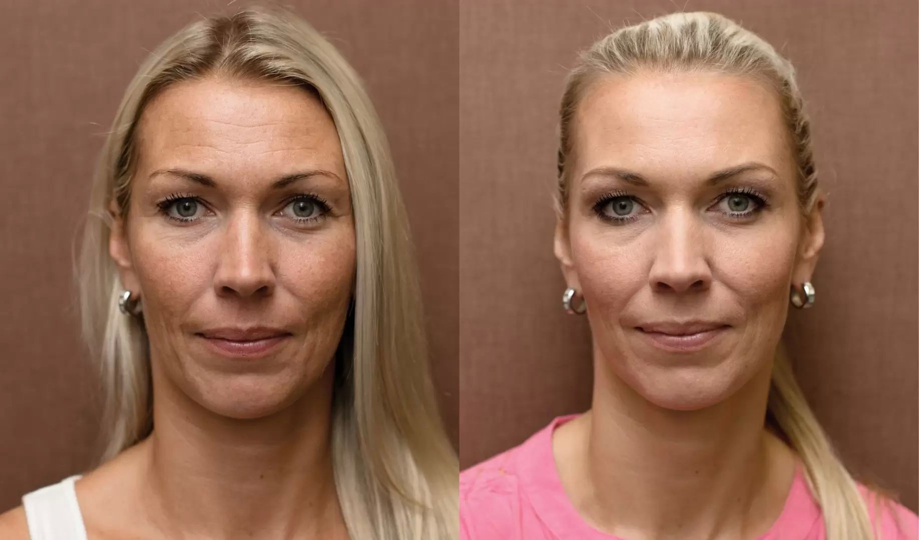 Kdy jít na Botox?