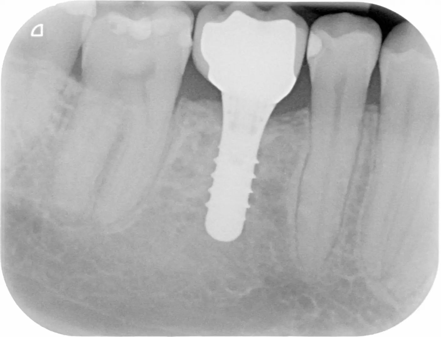 INTRAORAL PO