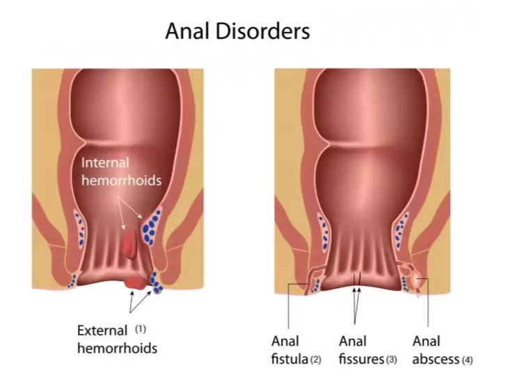 Kdy se Vstreba hemeroid?