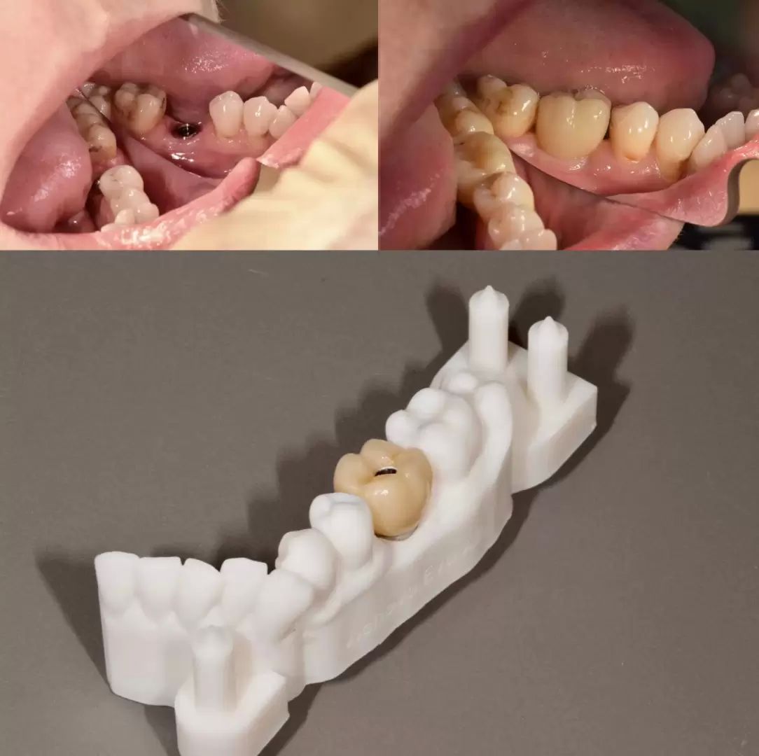 zubni implantaty 1