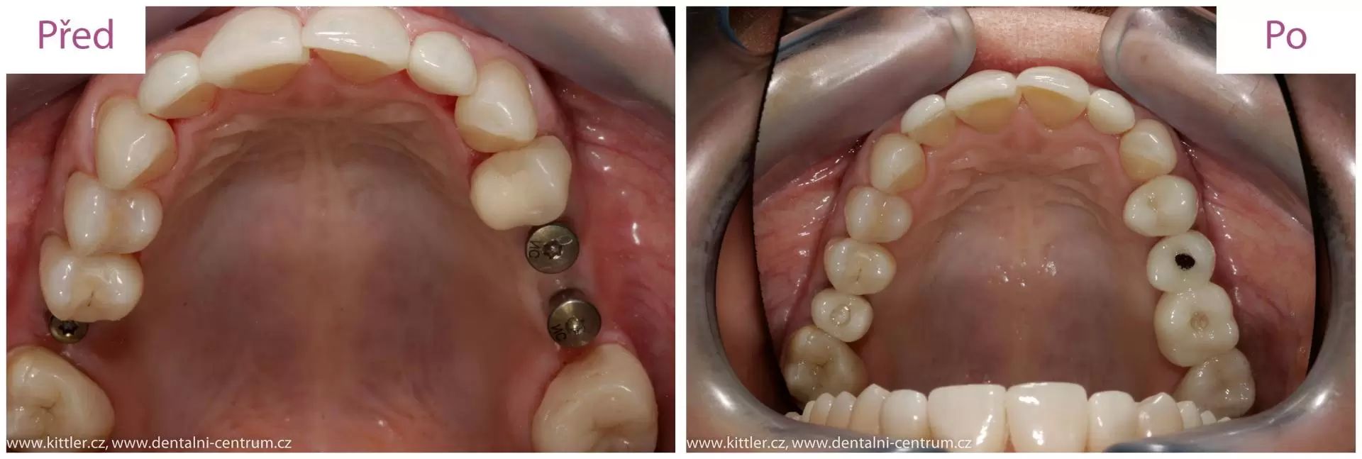 zubni implantaty 6
