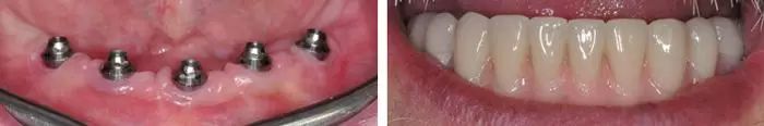 zubni implantaty 7