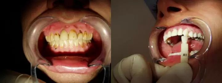 beleni zubu 5