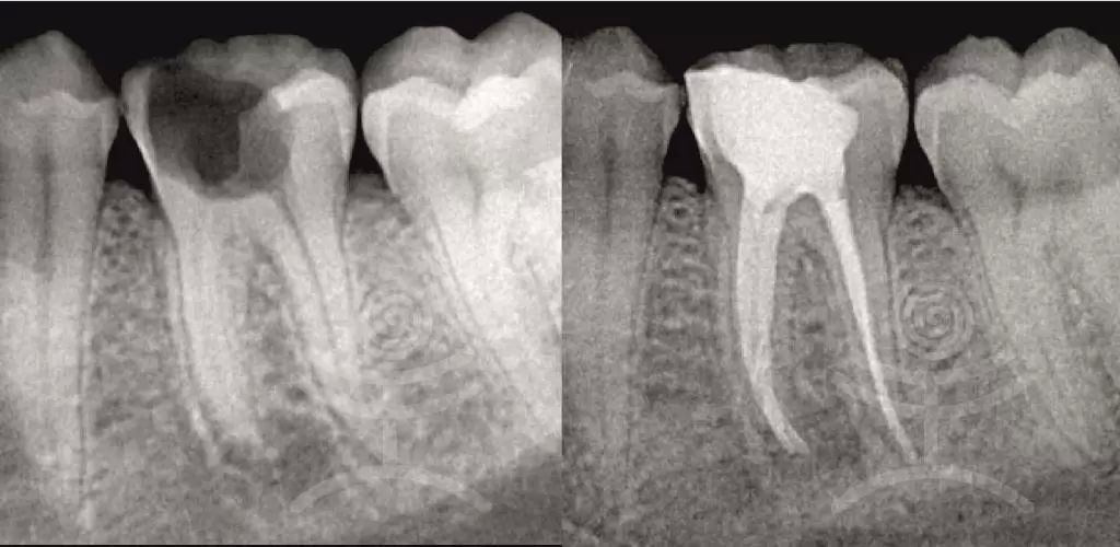 endodoncie 1